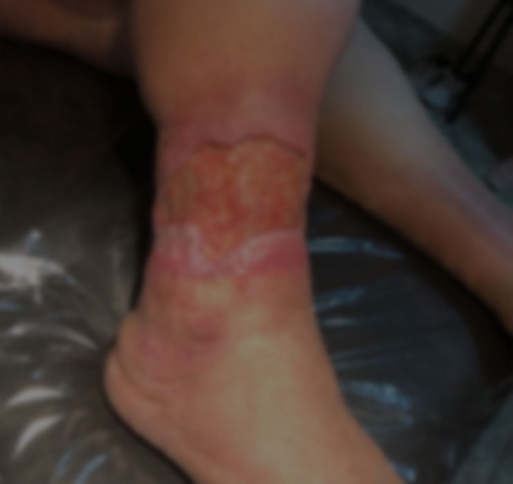 tratamiento_ulcera_venosa