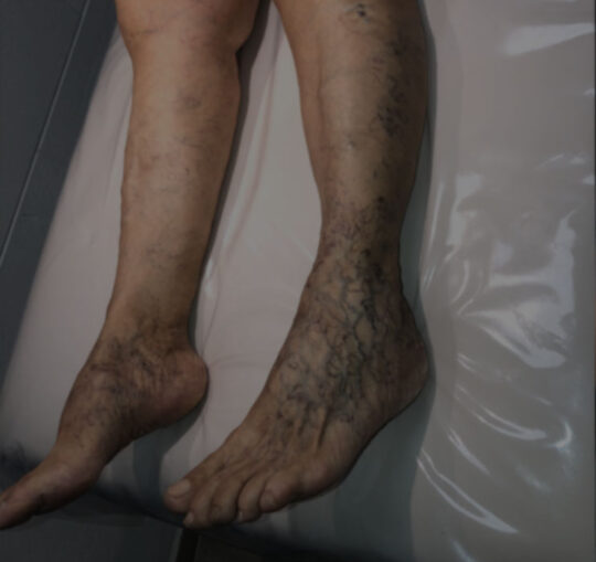 tratamiento_de_varices