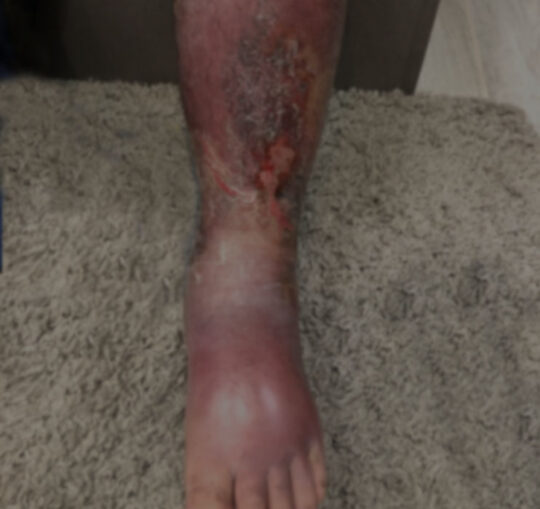 tratamiento_erisipela